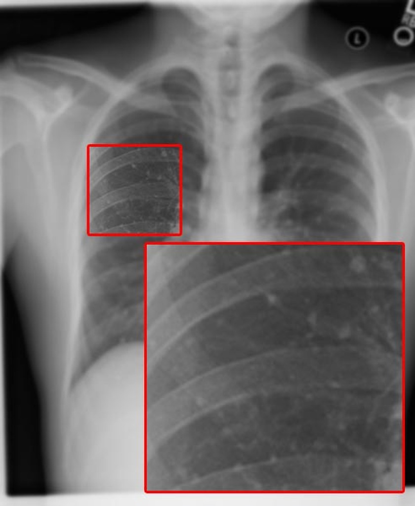 File:Varicella pneumonia 02.jpg