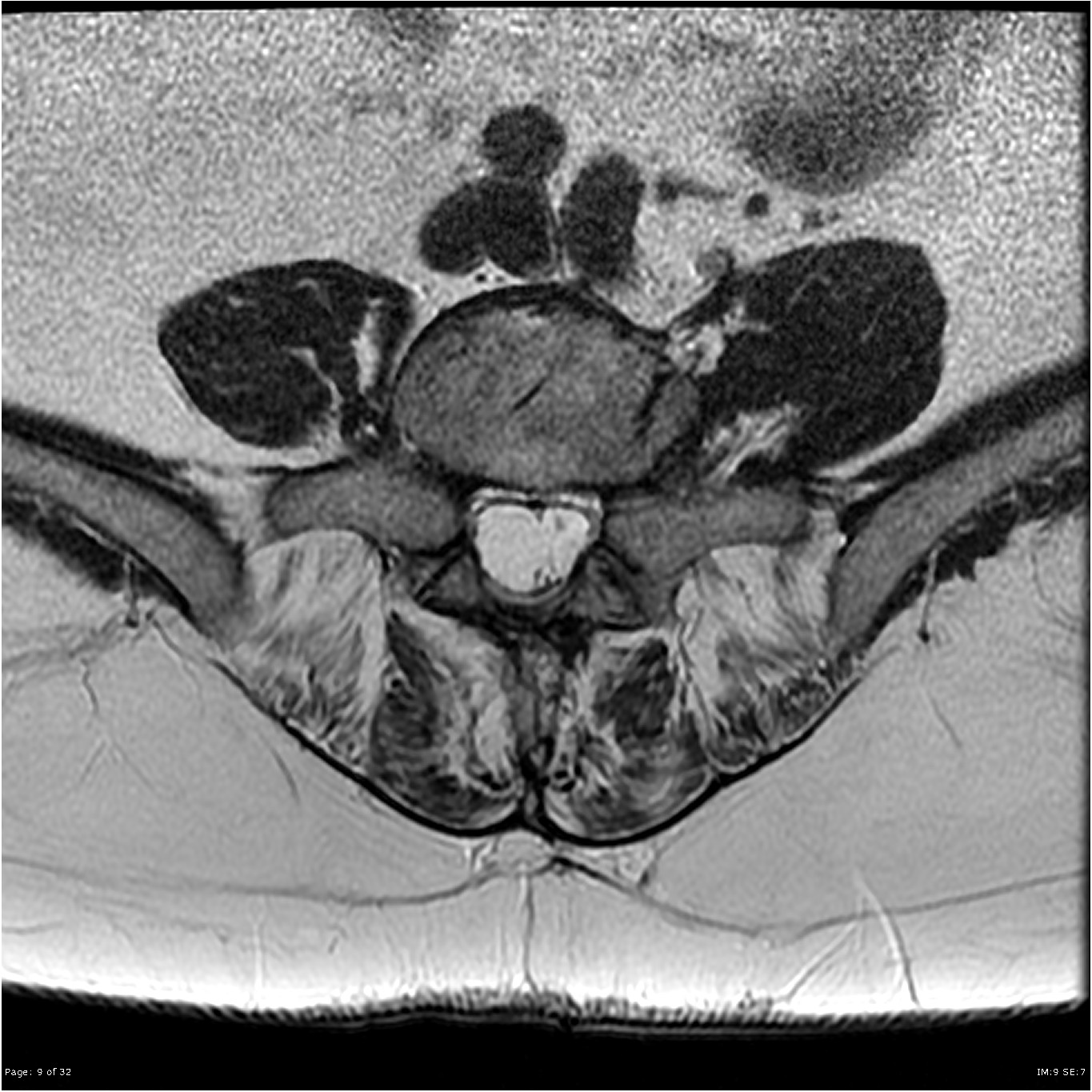 File:Arachnoiditis MRI image.jpg