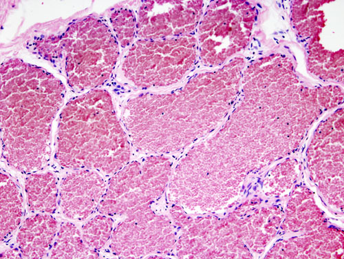 Histopathological image representing a cavernous hemangioma of the liver. Surgical excision of the lesion for the impending risk for rupture. H&E stain.[2]