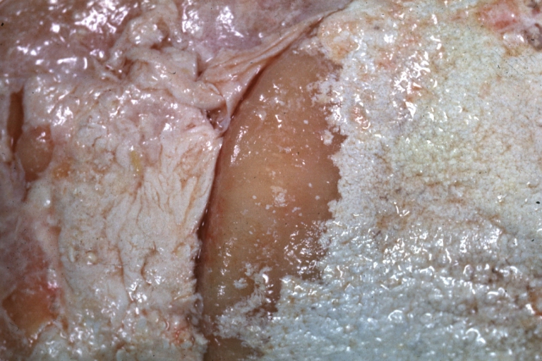 Bone, synovium: Gout: Gross natural color close-up of extensive uric acid deposits