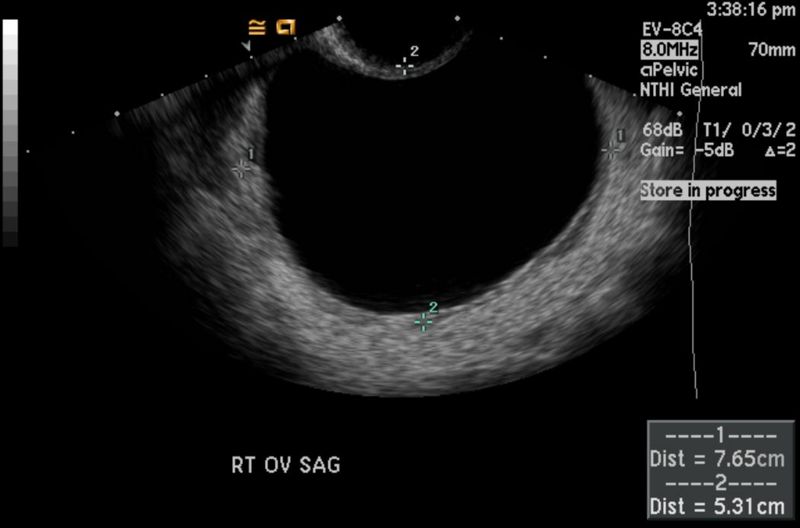 File:Ovarian cyst 103.jpg
