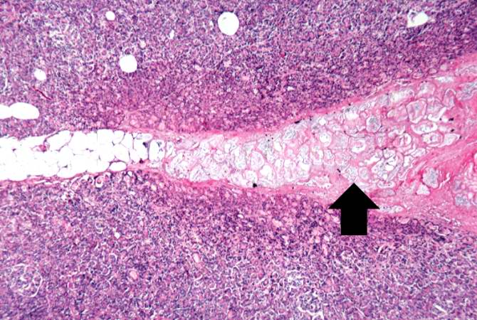 This is a higher-power photomicrograph of the fat necrosis involving the fat cells in the interlobular spaces (arrow) of the pancreas. Note the blue to purple staining of the calcium deposits within the fat cells.