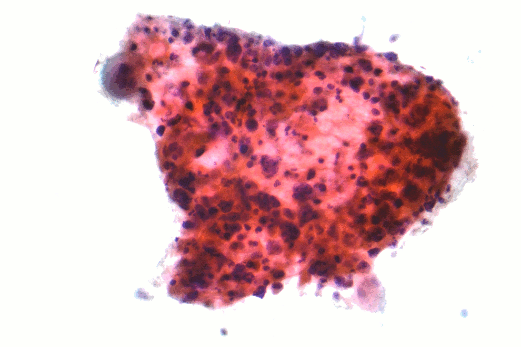 File:Squamous carcinoma lung cytology.gif