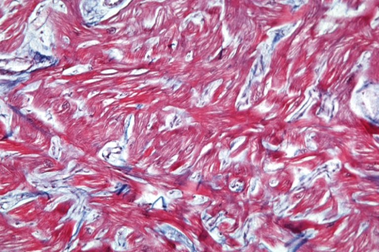Cardiomyopathy: Micro trichrome high mag marked myofiber disarray