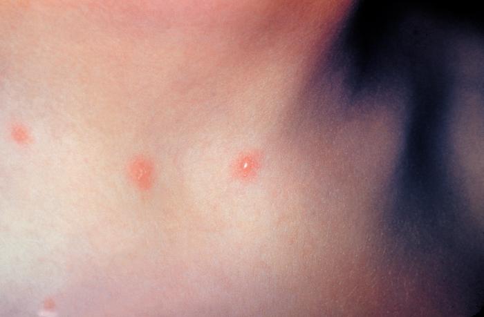 Patient with cervical skin lesions caused by chickenpox. From Public Health Image Library (PHIL). [1]