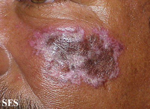 Discoid lupus erythematosus. Adapted from Dermatology Atlas.[11]