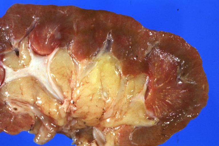 Kidney: Uric Acid In Medulla: Gross natural color cut surface of kidney uric acid easily seen