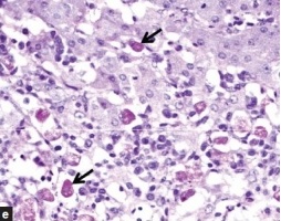 Amoebic liver abscess[15]