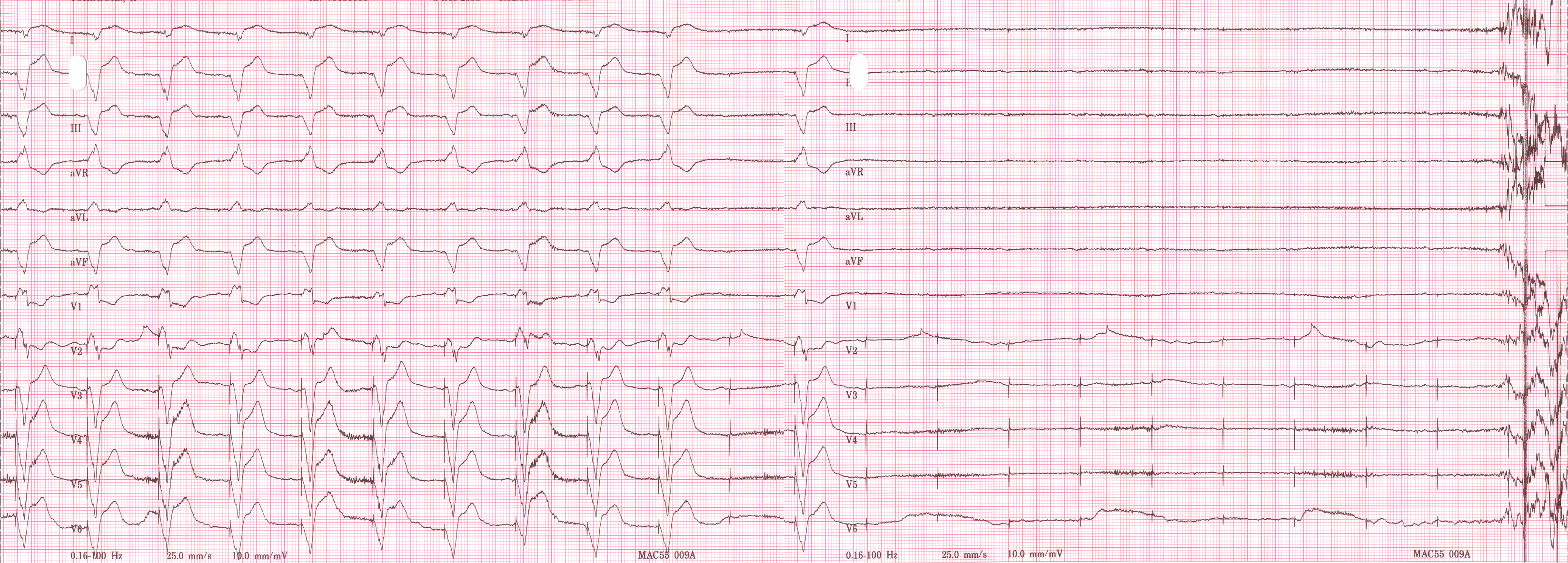 Pacemaker dependent asystole.jpg