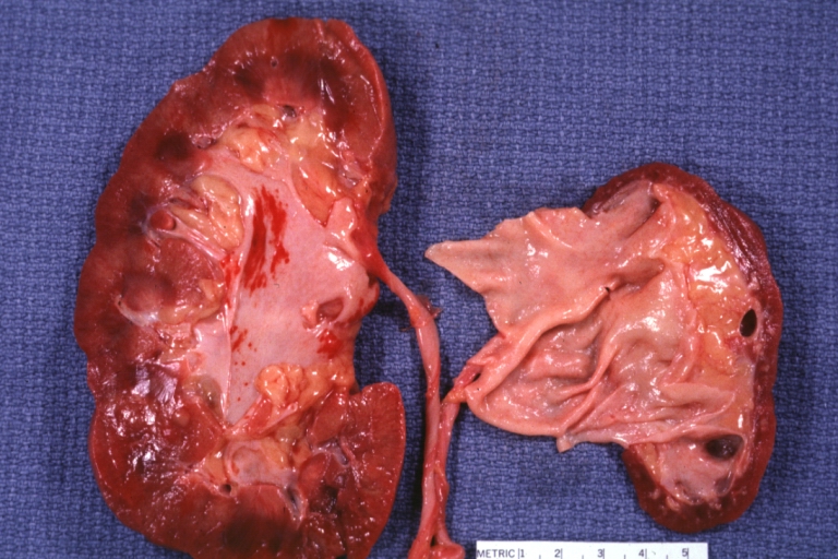Atherosclerosis: Kidney: Atrophy secondary to renal artery atherosclerosis: Gross, natural color, both kidneys one very atrophic the large left kidney weighed 220 grams and the small left one 90 gram