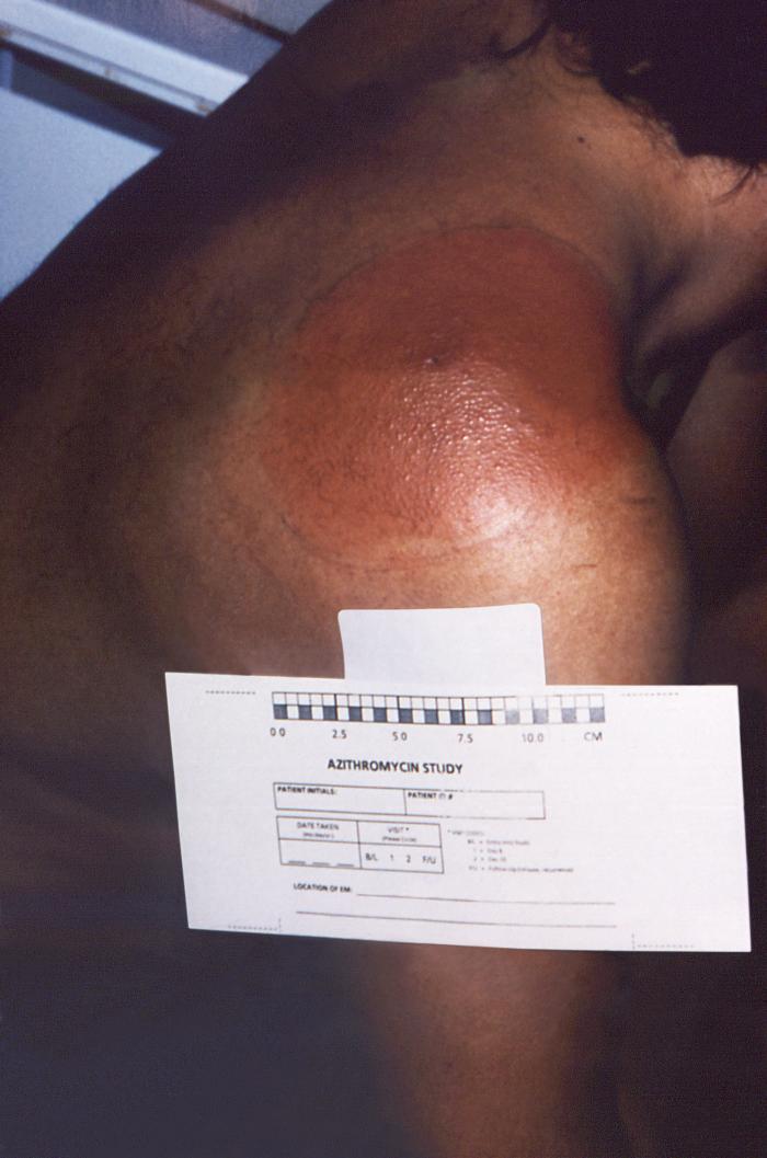Right posterior shoulder region of a patient who’d presented with the erythema migrans (EM) rash characteristic of what was diagnosed as Lyme disease, caused by Borrelia burgdorferi. - Source: Public Health Image Library (PHIL).