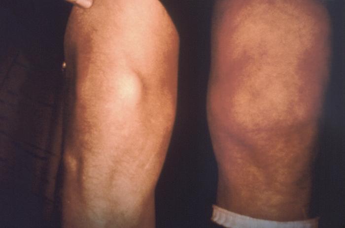 This Lyme disease patient presented with the signs and symptoms indicative of arthritic changes to his right knee due to a Borrelia burgdorferi bacterial infection. From Public Health Image Library (PHIL). [1]