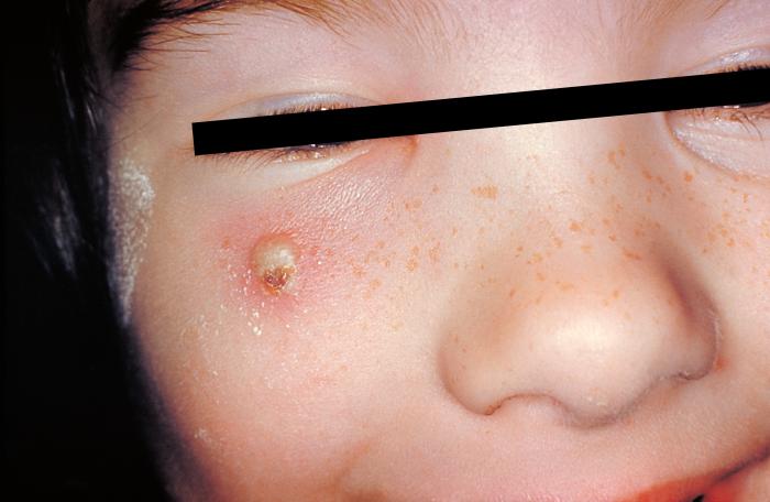 Girl with a secondary skin infection due to chickenpox.