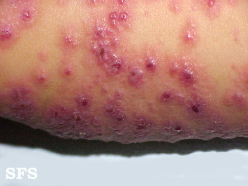 File:Eczema herpeticum09.jpg