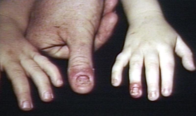 Paronychia due to Candida; nail diseases