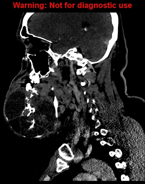 File:Saggital soft tissue window ameloblastoma.jpg