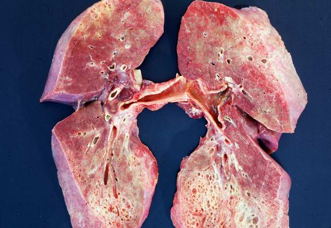 This is a gross photograph of cut section of the lungs from this patient. Note the extensive fibrosis of the lung parenchyma.