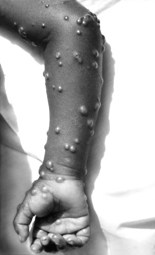 File:Smallpox 5.jpg