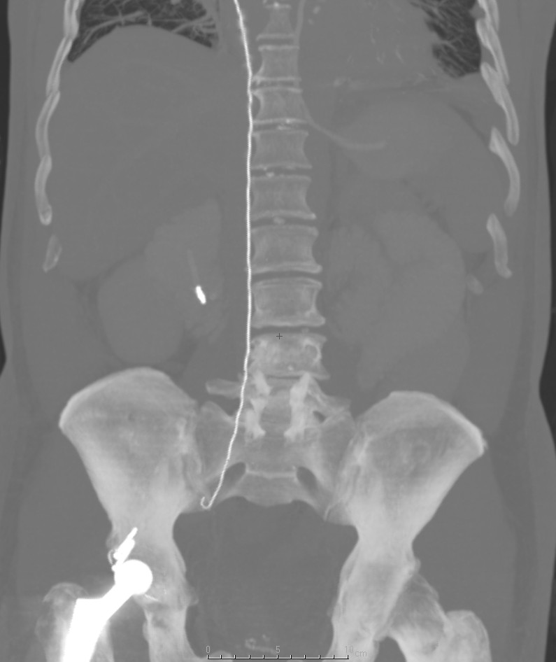 This patient was transfered to ICU from another hospital. On examination of their abdomen a wire was noted to project through the right atrium, down the IVC to end in the right iliac vein. The J-shaped tip gave the game away... a right jugular CVC had been placed, and the wire used for the insertion pushed in with the catheter. This guide wire was successfully retrieved from the groin, without complication. (Image courtesy of Dr Frank Gaillard)