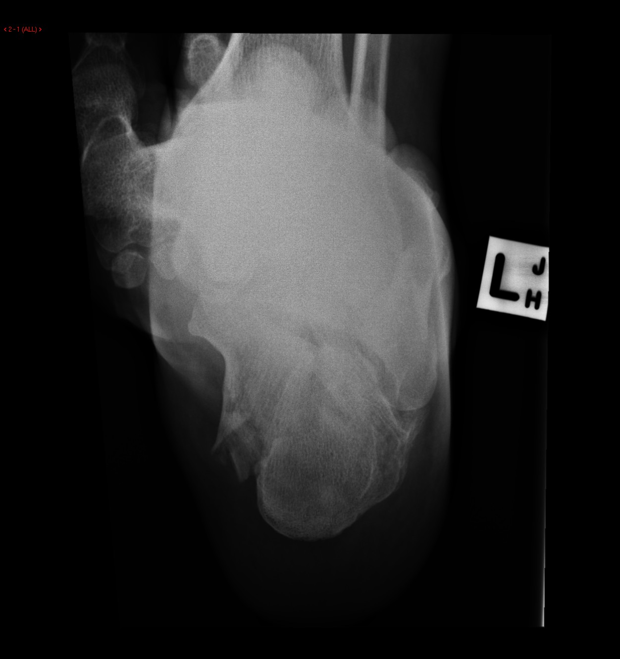 Plain films show a comminuted fracture of the left calcaneus with a flattening of Bohler's angle.