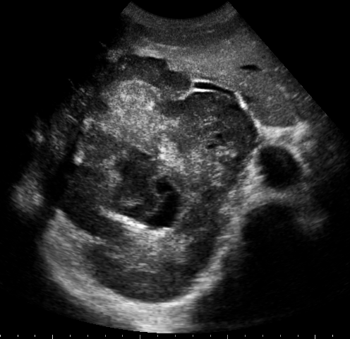 File:HCC ultrasound1.png