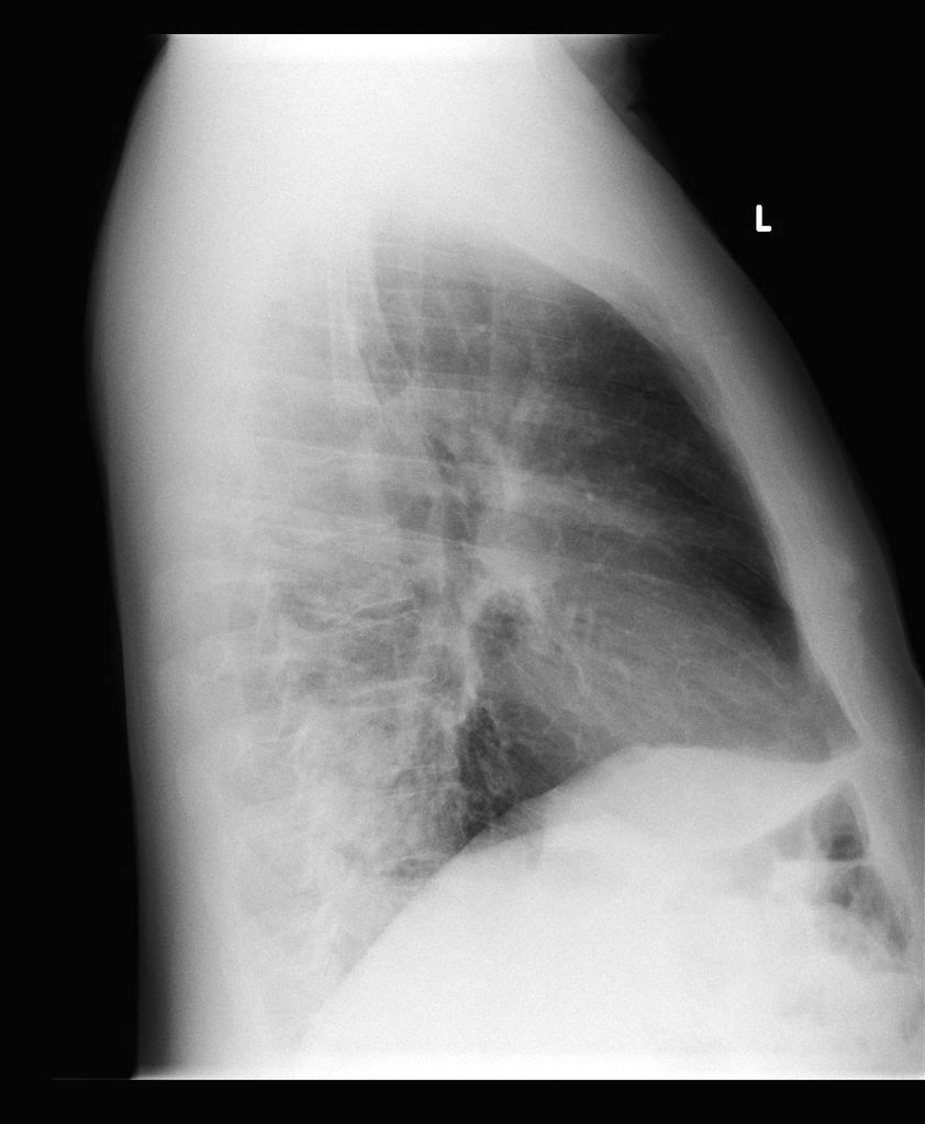 File:Left-lower-lobe-pneumonia-10.jpg