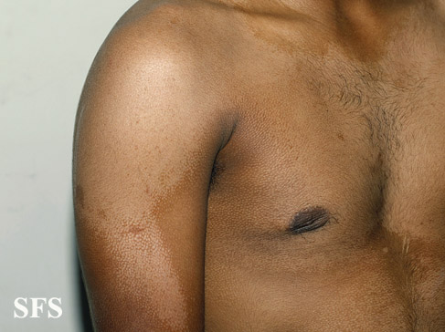 Pityriasis versicolor. With permission from Dermatology Atlas.[1]