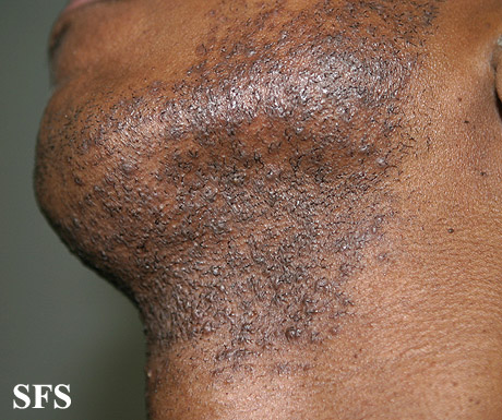 Pseudofolliculitis barbae. Adapted from Dermatology Atlas.[1]