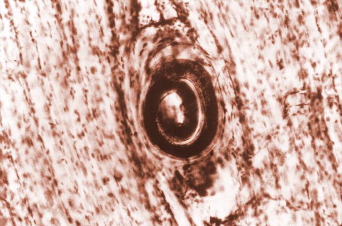 This is a photomicrograph depicting a Trichinella spiralis cyst seen embedded in a muscle tissue specimen, in a case of trichinellosis.