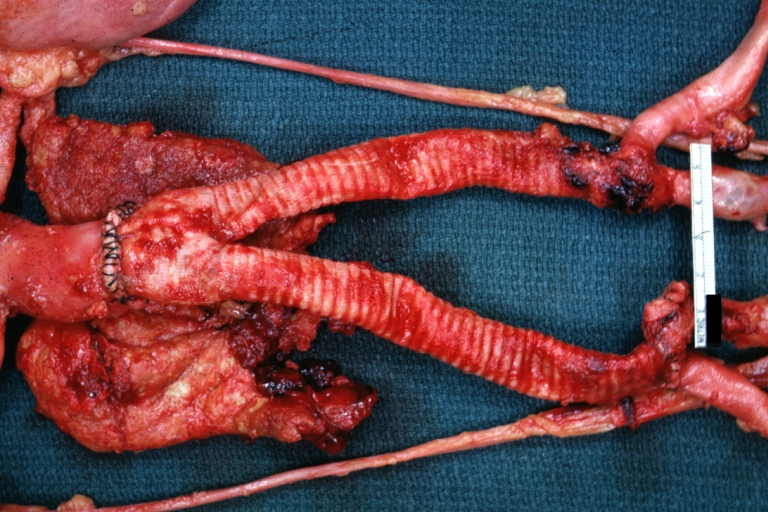 Aortobifemoral Prosthesis: Gross natural color close-up view of nicely dissected prosthesis extending from below renals to common iliac arteries portion of atherosclerotic aneurysm behind prosthesis
