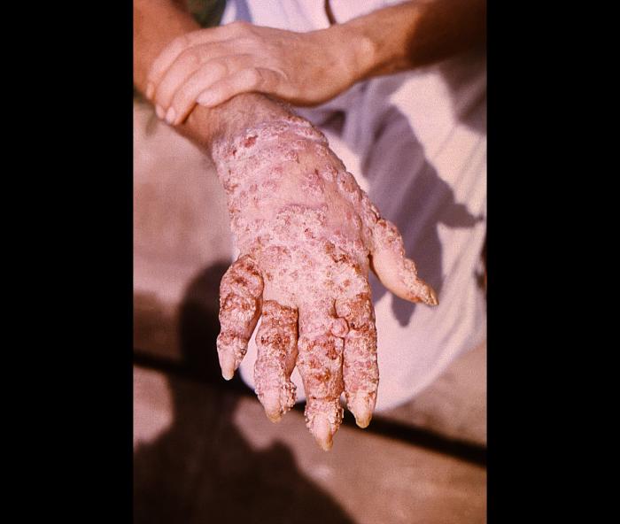 Pathologic changes in a Brazilian patient’s right hand after having been infected by what was determined to be Phialophora verrucosa fungal organisms. From Public Health Image Library (PHIL). [1]
