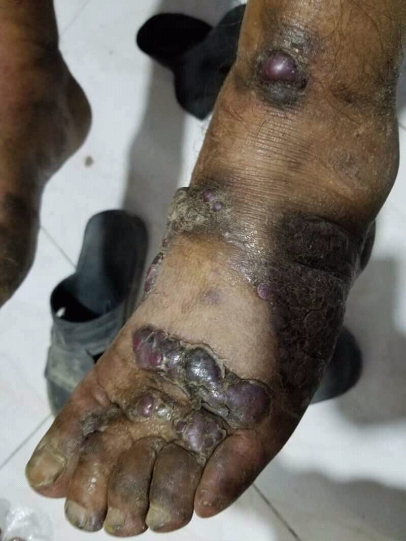 Lesion in a foot. Source: Wikimedia Commons.[15]