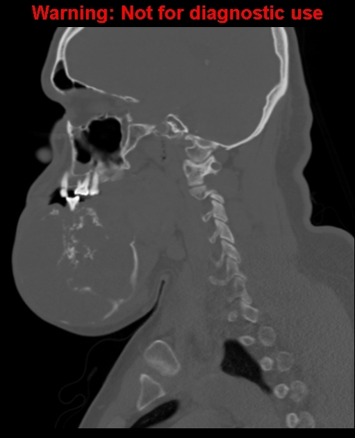 File:Saggital bone window ameloblastoma.jpg