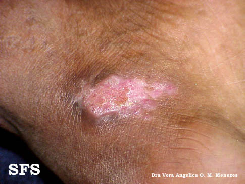 Chromomycosis. Adapted from Dermatology Atlas.[1]