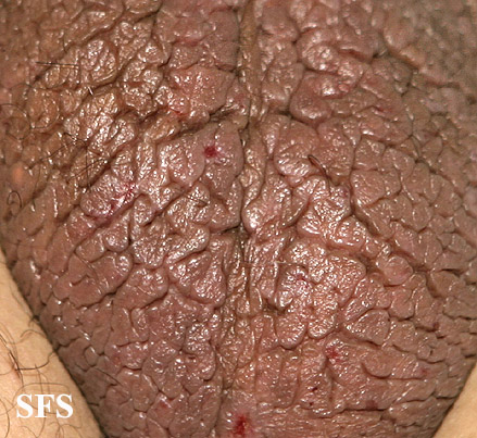 Lichen simplex. Adapted from Dermatology Atlas.[1]