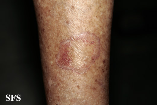 Porokeratosis of mibelli. With permission from Dermatology Atlas.[5]