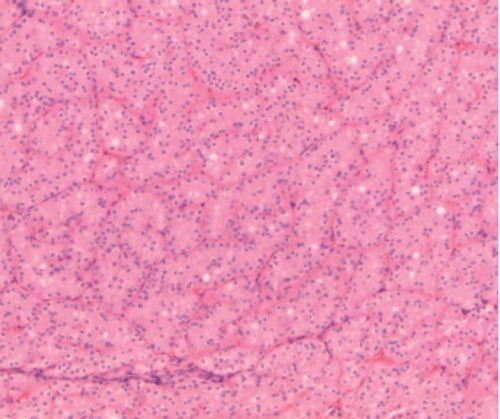 File:Renal oncocytoma HE.png
