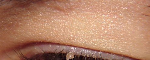 Warts filiformis. Adapted from Dermatology Atlas.[1]