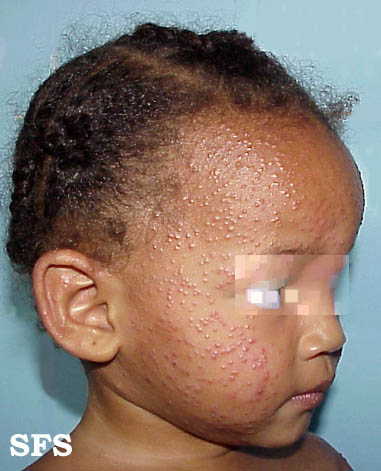 File:Acrodermatitis infantile papular 03.jpeg