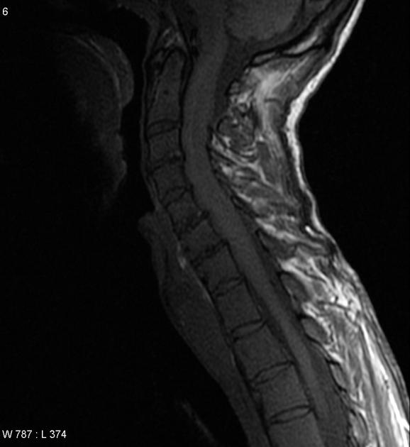 Sagittal spinal T1 weighted MRI image illustrating hypointense diffuse signal of chronic lymphocytic leukemia. [2]