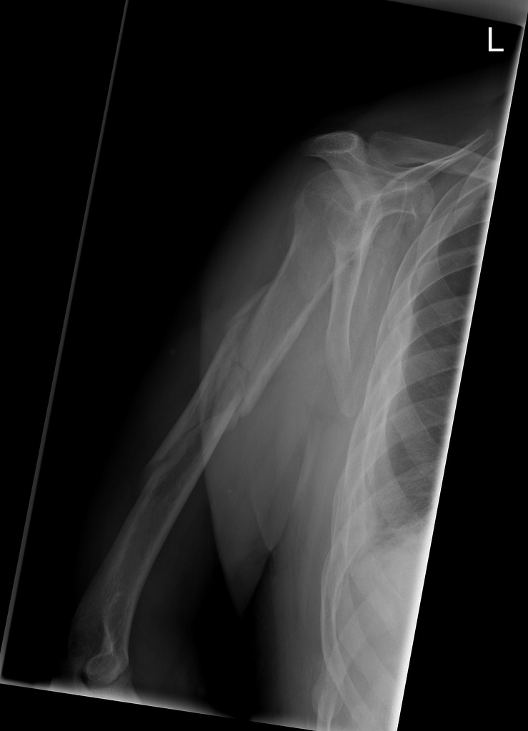 File:Comminuted-humeral-shaft-fracture (1).jpg