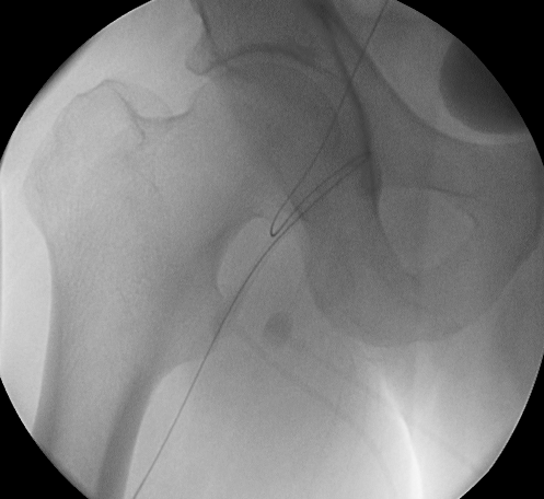 Complication during right femoral artery puncture. Copyleft image courtesy of C. Michael Gibson.