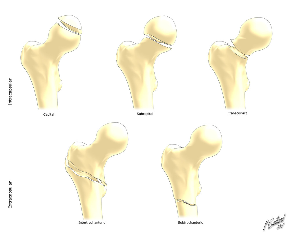 File:Proximal-femoral-fractures-illustration.jpg
