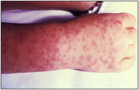 Early stage rash in a patient with RMSF