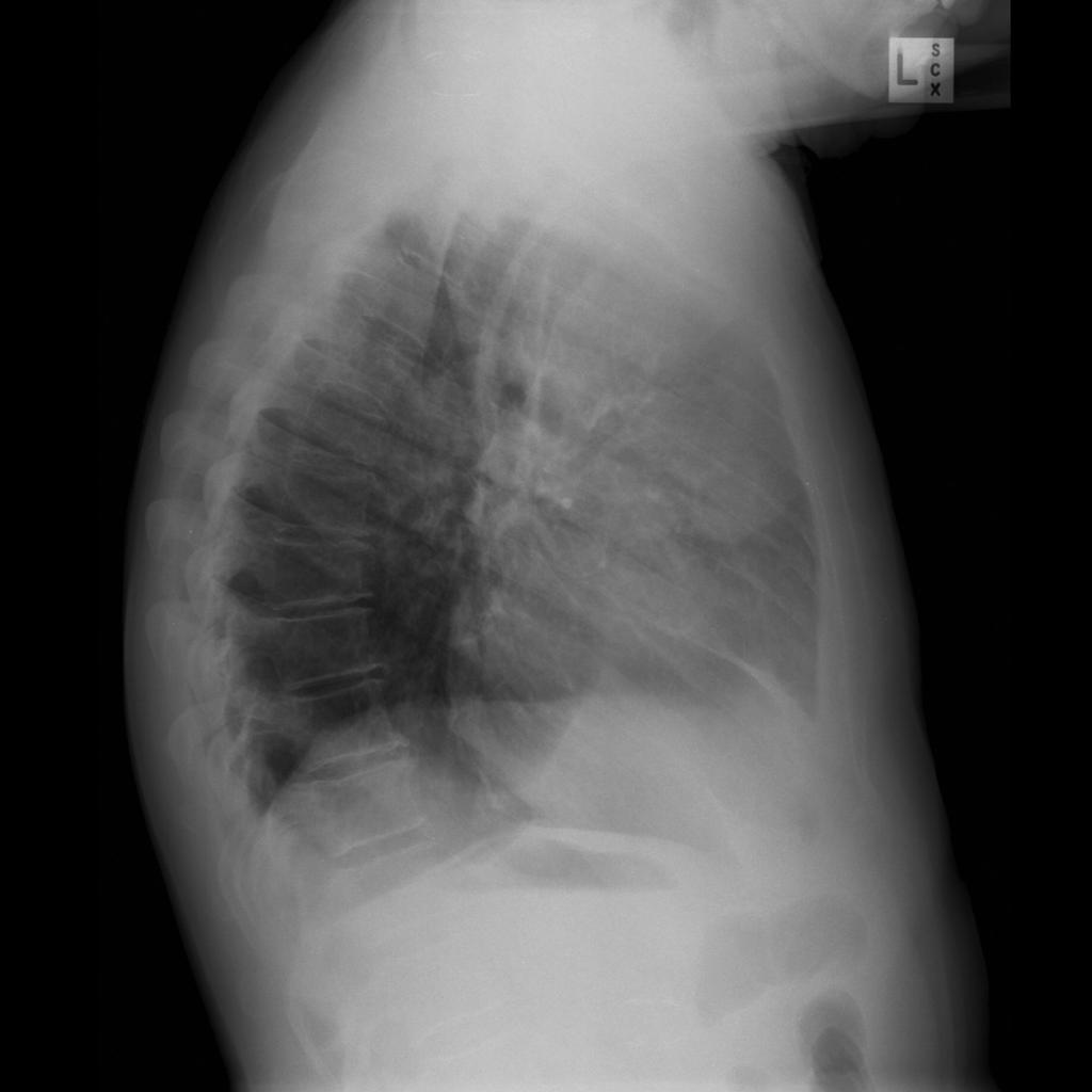 File:Small-cell-lung-cancer-1-2.jpg