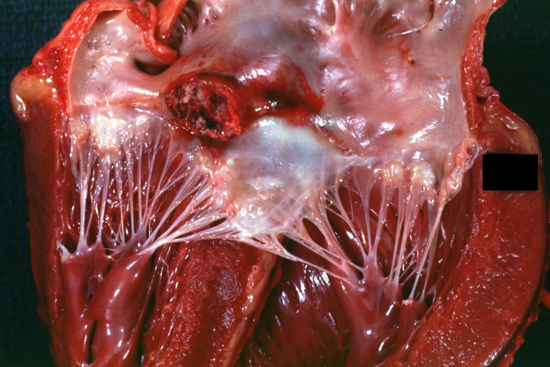 Bacterial Endocarditis: (Gross) Aortic valve prosthesis ring infection extending into left atrium.