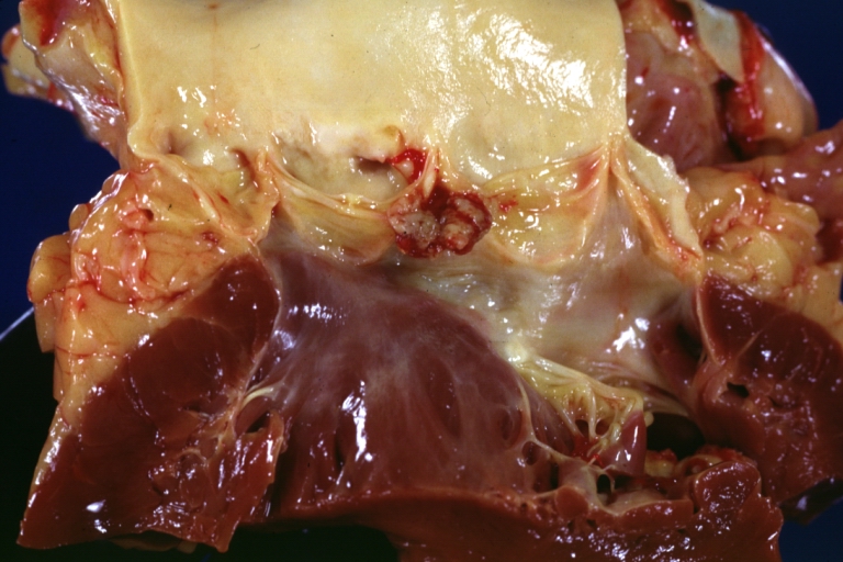 Thrombotic Nonbacterial Endocarditis Infected: Gross close-up natural color vegetations or aortic cusps well shown secondarily infected with staphylococci micro is mitral valve also involved see and case of 8 year survival breast intraductal papillary adenocarcinoma with extensive metastases