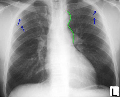 File:COA x-ray labeled.jpg