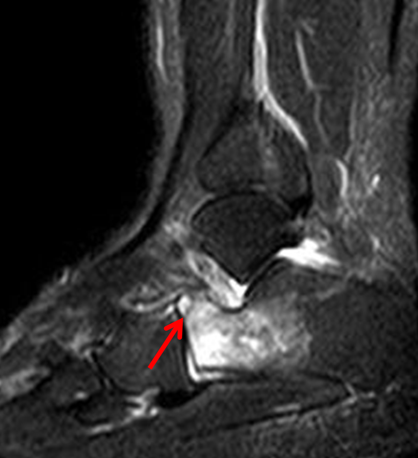 Small subtle non displaced fissure fracture of persistent dark signal intensity is seen traversing the anterior beak of the calcaneus bone with surrounding extensive marrow edema