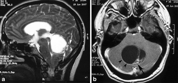 Pilocytic astrocytoma in a 26-year-old woman arising in the vermis. a A sagittal T2-weighted image shows a hyperintense cystic mass of the cerebellar vermis with a peripherally located mural nodule (arrows) compressing the fourth ventricle. b An axial contrast-enhanced T1-weighted image demonstrates intense enhancement of the mural nodule (arrow), as well as cyst wall enhancement (arrowheads).[2]